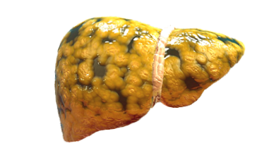 Fatty liver illustration